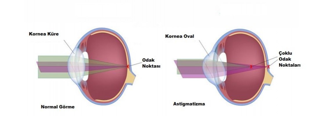 Astigmatizma Nedir?